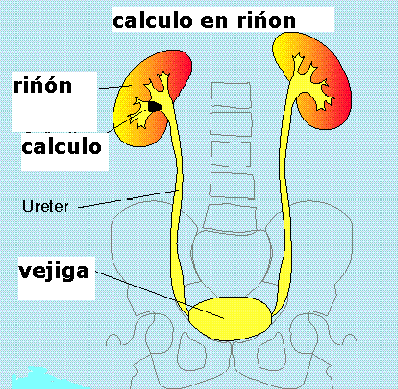 Cálculo renal